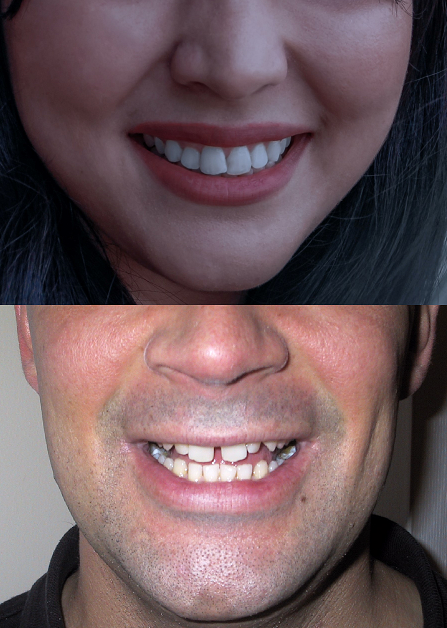 Comparison of teeth gaps for use in Physiotyping, a visual personality test that provides a type similar to MBTI, Socionics, and Objective Personality System.